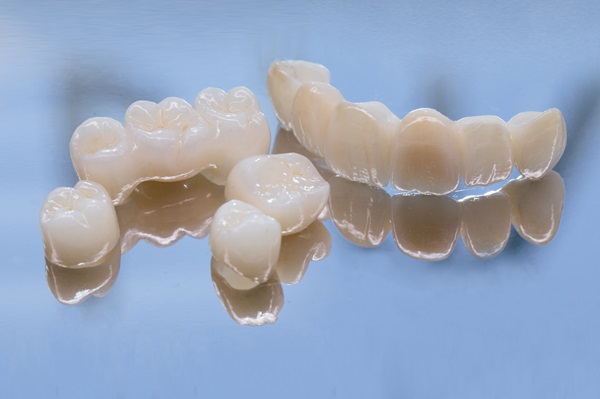 What Is A Dental Bridge?