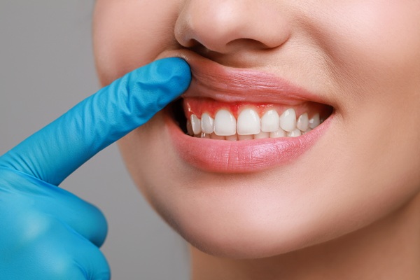 Gum Disease Treatment: Stages, Best Therapies, And How To Prevent Its Return